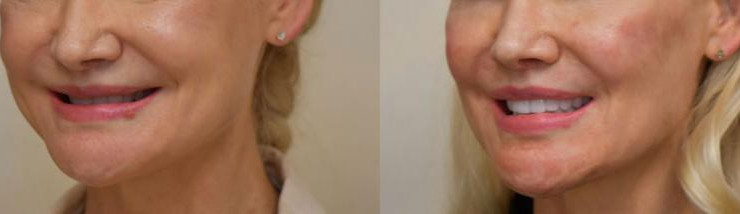 Collapsed Bite Before & After