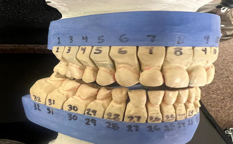 Collapsed bite correction and restoring desired asthetics1