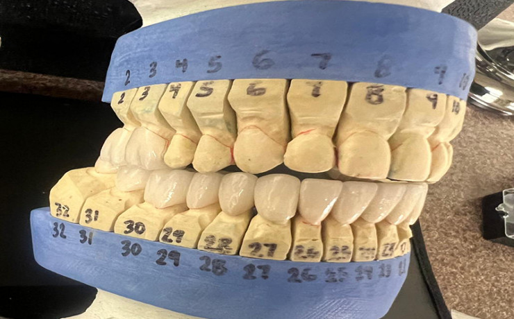Collapsed bite correction and restoring desired asthetics3