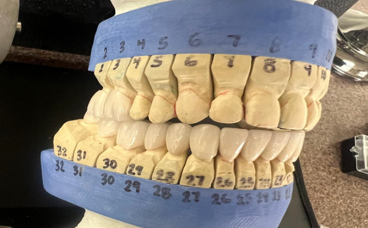 TMJ treatment and restoring the loss of vertical dimension without grinding the teeth1
