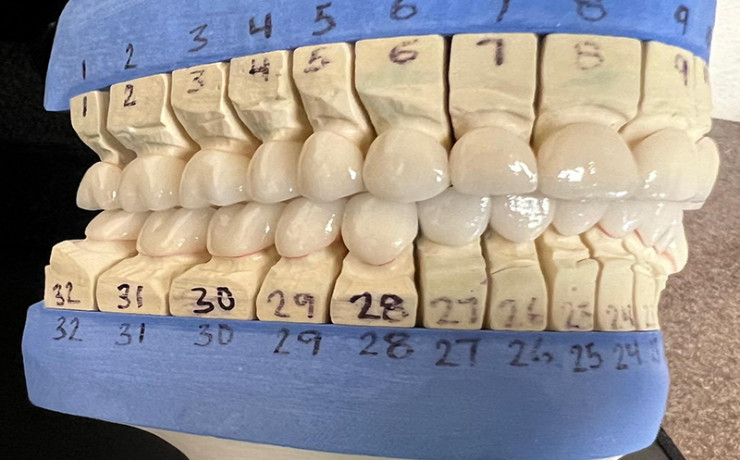 TMJ treatment and restoring the loss of vertical dimension without grinding the teeth5