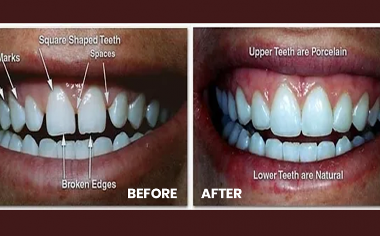 most-natural-looking-veneers